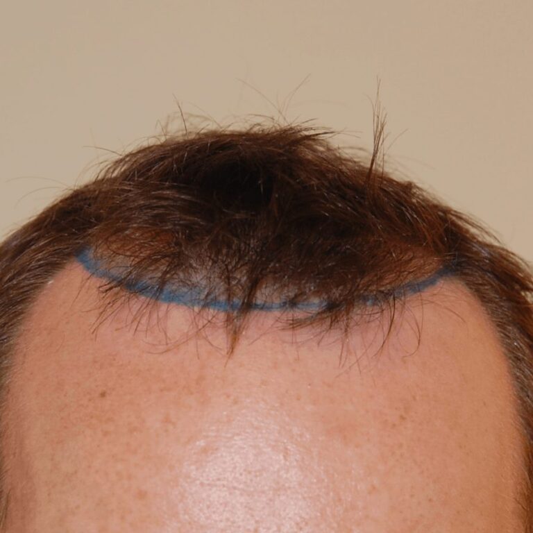 FUE Transplant - Case 21 — before