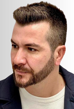 after hair transplant