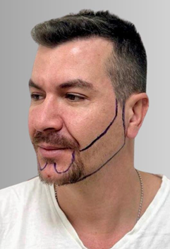 Before beard hair transplant