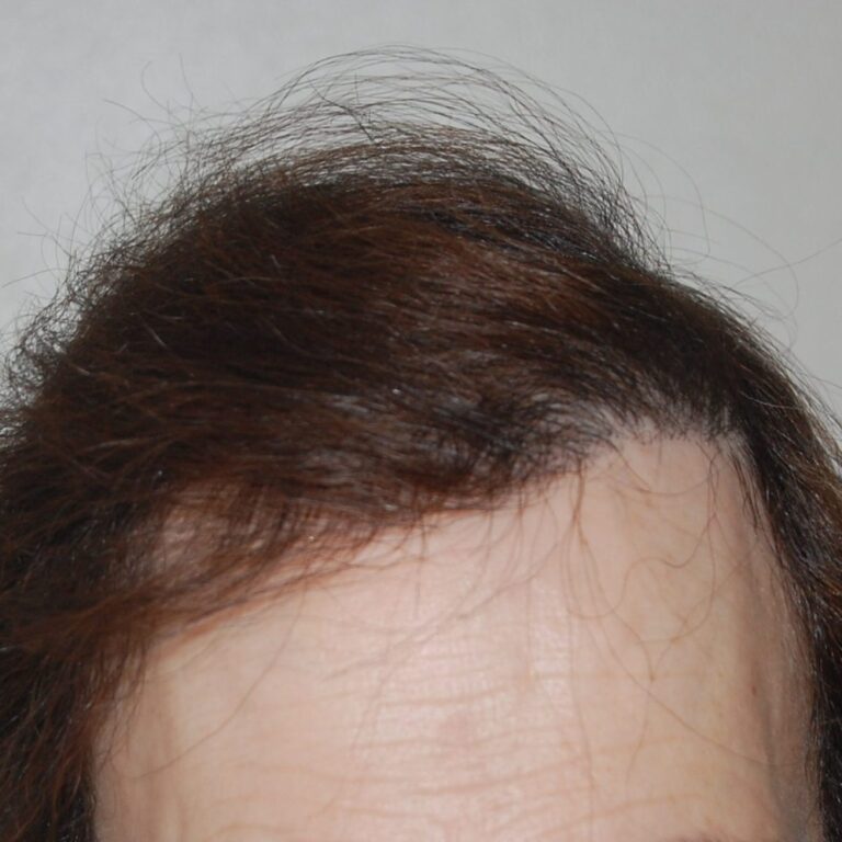 FUE & FUT Combo - Case 4 — after