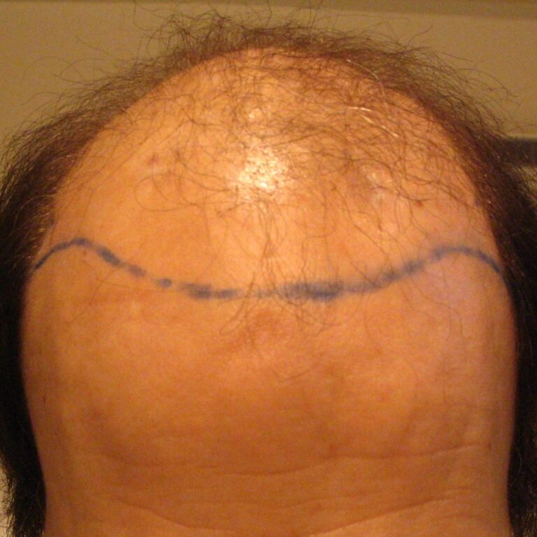 FUE & FUT Combo - Case 4 — before