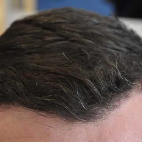 FUE Transplant - Case 5 — after