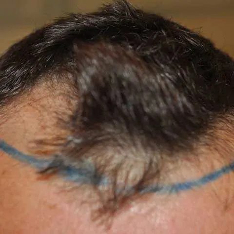 FUE Transplant - Case 5 — before
