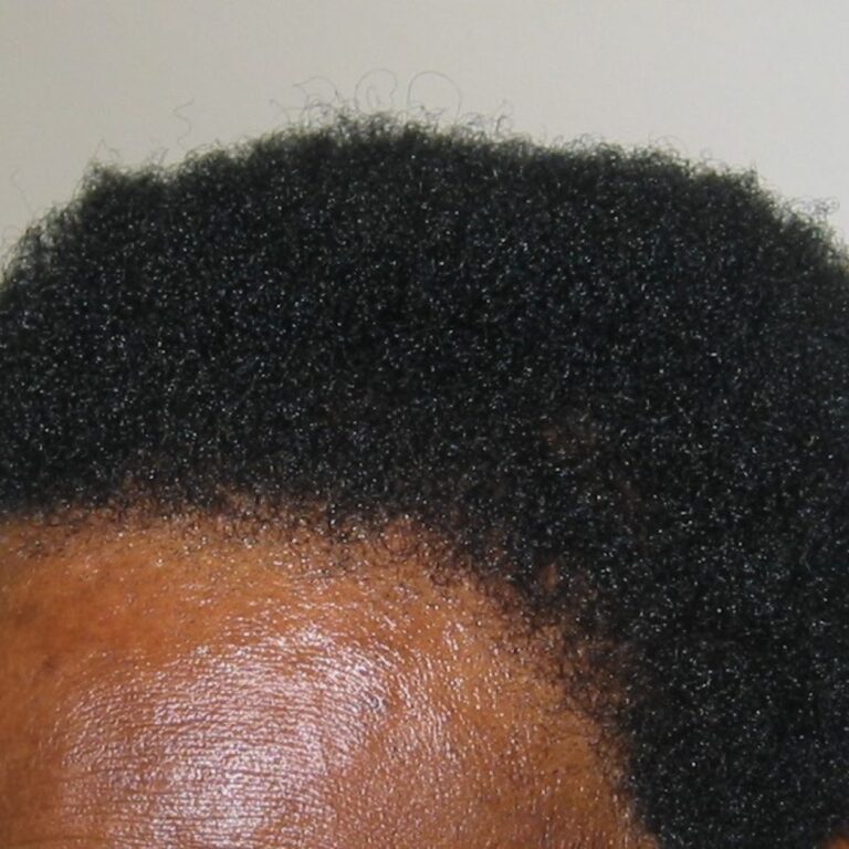 FUT Transplant - Case 6 — after
