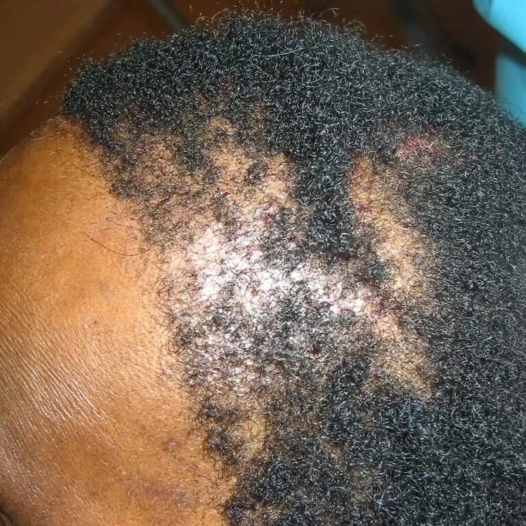 FUT Transplant - Case 6 — before