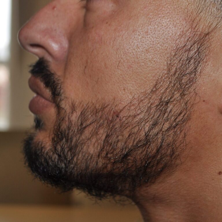 FUT Transplant - Case 7 — after