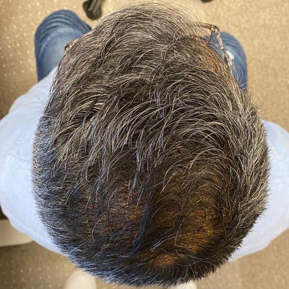 FUE Transplant - Case 8 — after