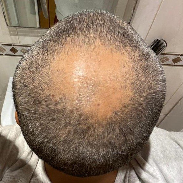 FUE Transplant - Case 8 — before