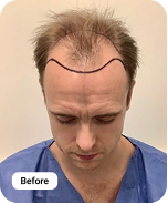 Before hairline coverage