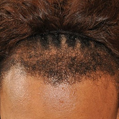 Jessica after FUT hair restoration