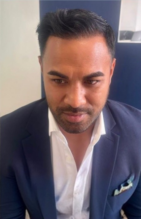 FUE hair transplant after