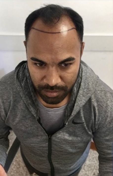 FUE hair transplant before