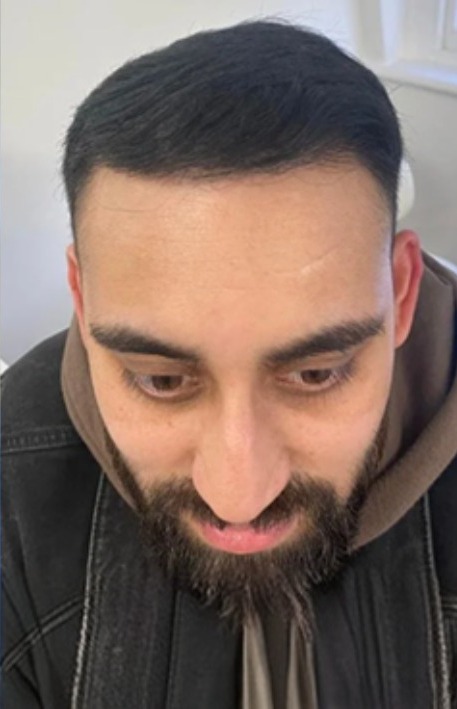 FUE hair transplant after