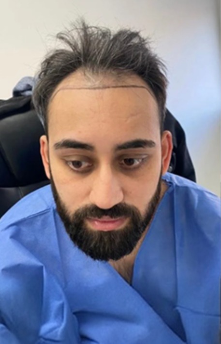 FUE hair transplant before