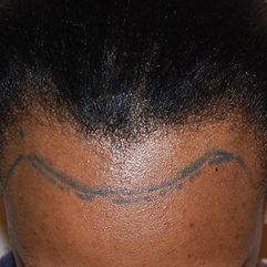 Jessica before FUT hair restoration