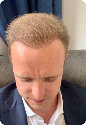 After hairline coverage