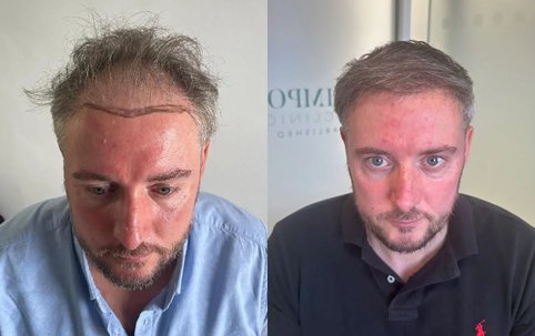 Before and after FUE hair transplant at Wimpole Miami
