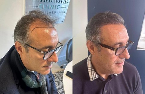 Before and after FUE hair transplant at Wimpole Miami