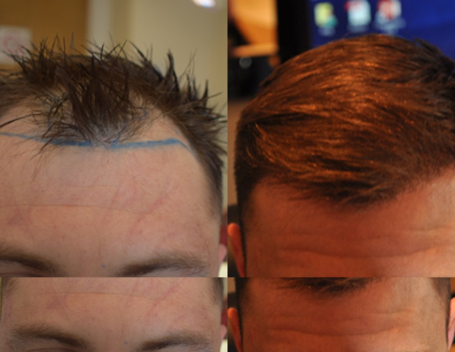 Before and after hair transplant at Wimpole New York