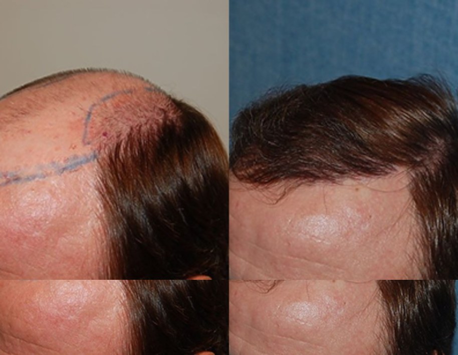 Before and after hair transplant at Wimpole New York