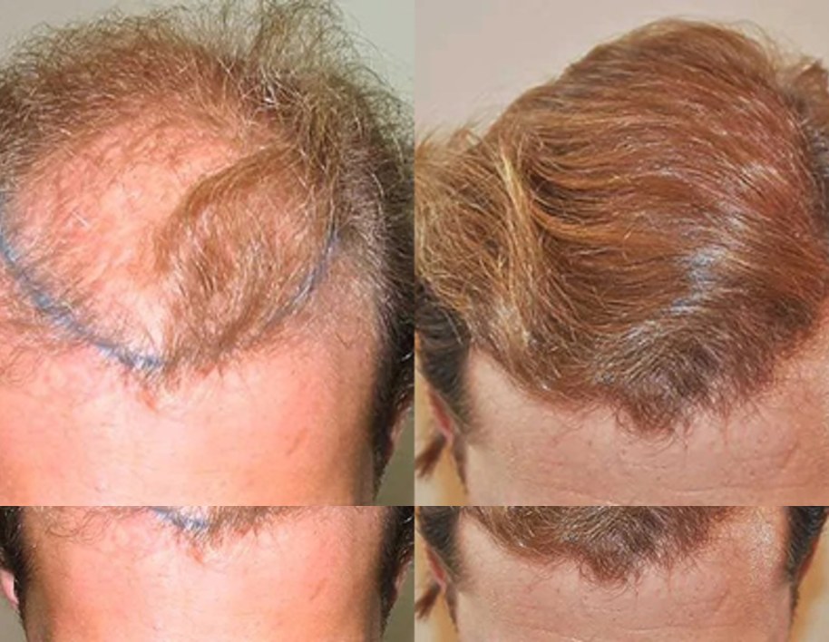 Before and after hair transplant at Wimpole New York