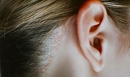 Scalp Psoriasis