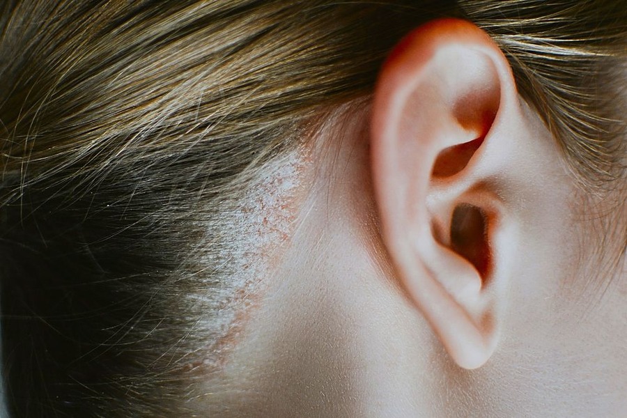 Scalp Psoriasis