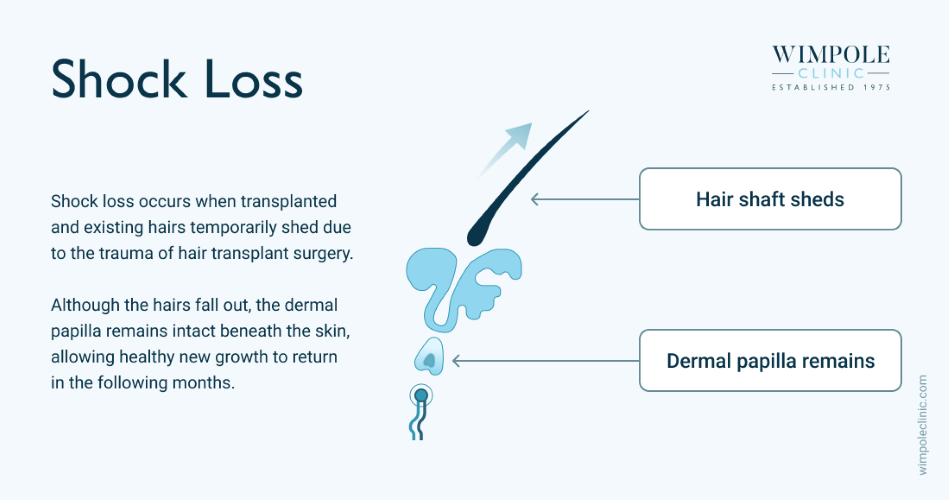 Shock Loss