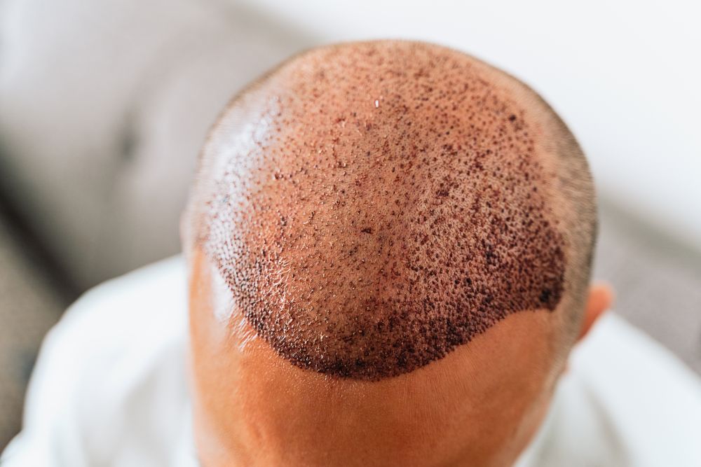 Hair Transplant Scabs: What&rsquo;s Normal and What&rsquo;s Not