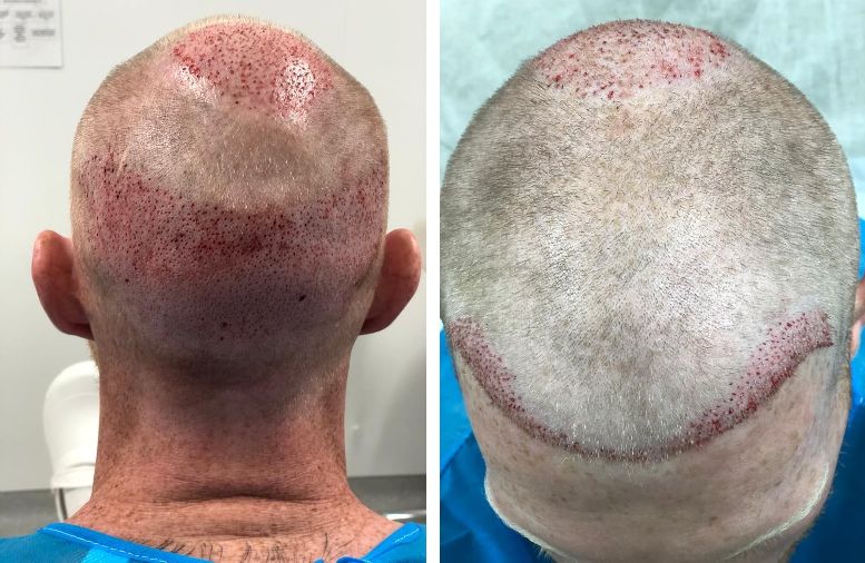 Ben Stokes' donor and recipient areas immediately post-surgery