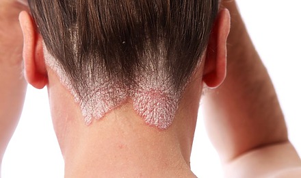 Seborrheic Dermatitis Hair Loss