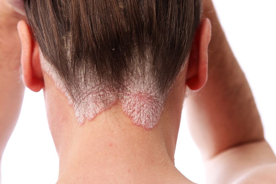 Seborrheic Dermatitis Hair Loss