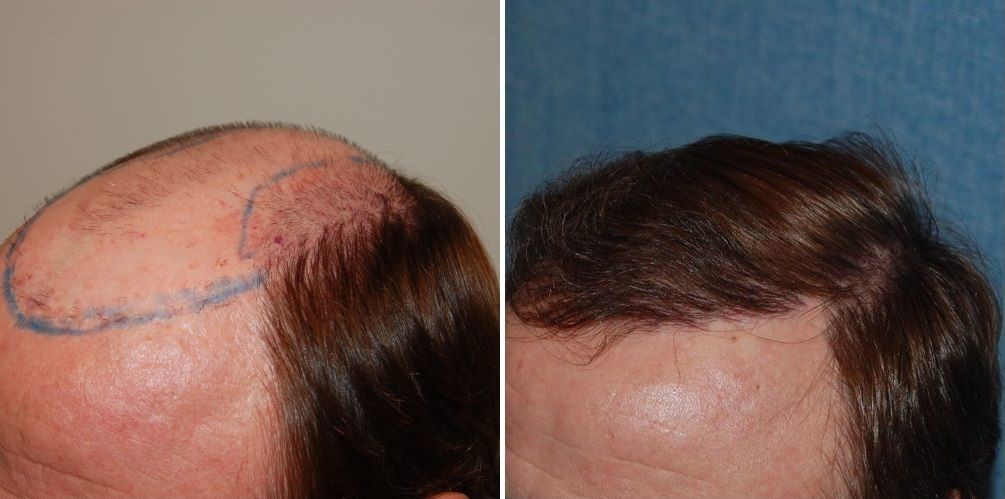Patient&rsquo;s temple before and 7 months after 1900 grafts FUT hair transplant