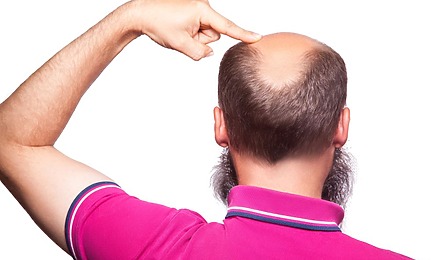 How Many Hair Transplants Can A Person Have