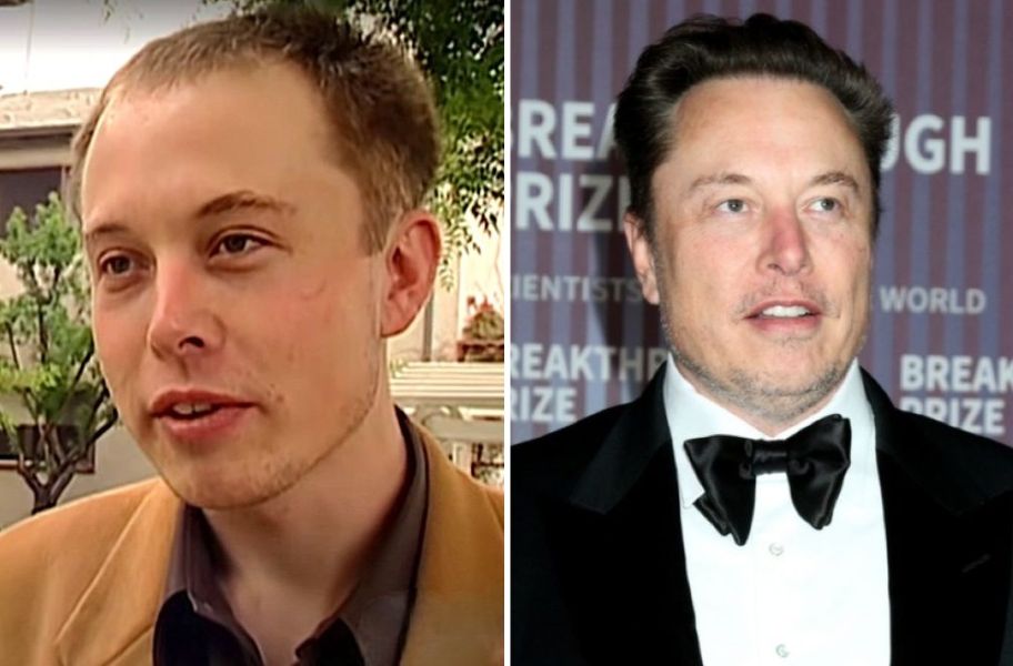 Elon Musk&rsquo;s Hair Transplant: Full Timeline, Cost and Results