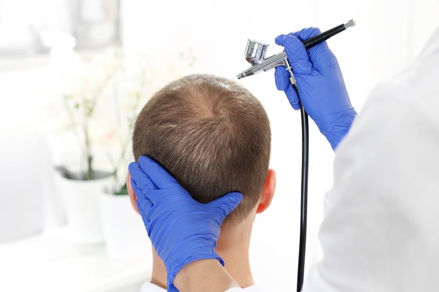 Hair Transplant Alternatives
