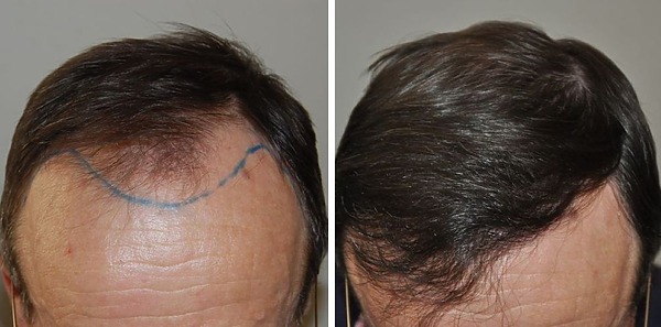 1500 grafts hair transplant