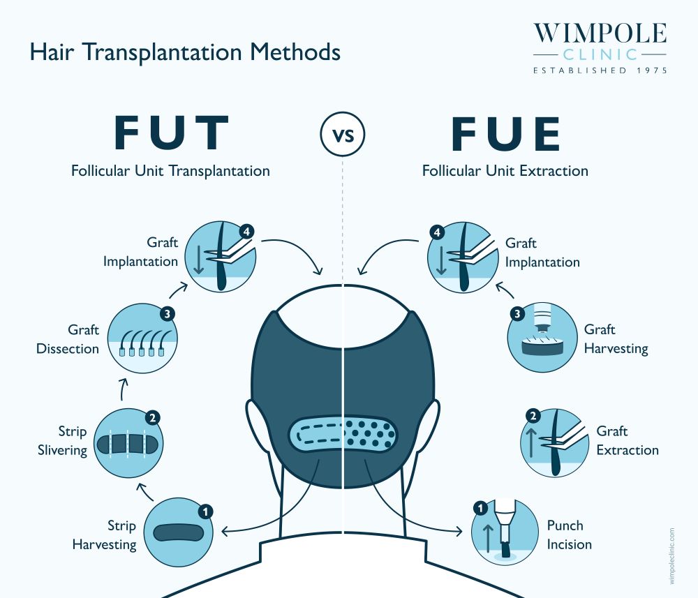 FUE vs FUT for widow&rsquo;s peaks infographic