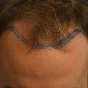 Before hair transplant