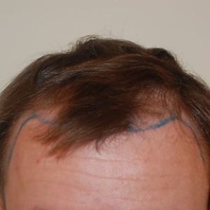 Before hair transplant
