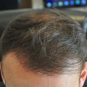 After hair transplant