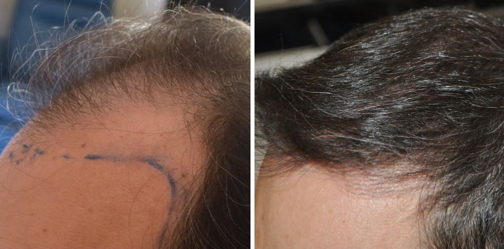 Patient&rsquo;s temple before and 7 months after 2800 grafts FUT hair transplant