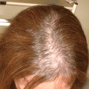 Before the hair transplant