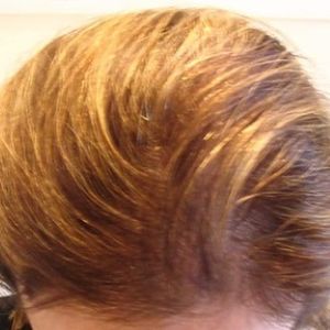 After the hair transplant