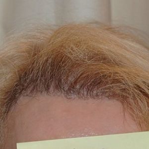 After the hair transplant