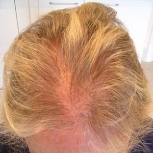 Before the hair transplant