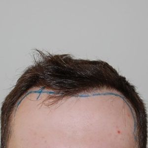 Before hair transplant