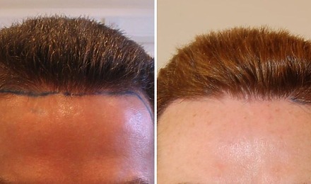 500 Grafts Hair Transplant