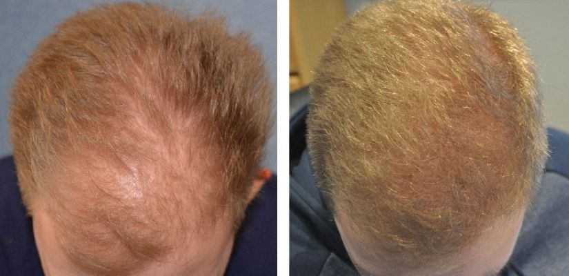Before and 12 months after an FUE hair transplant