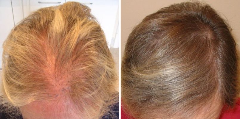 Before and 6 months after a female FUT hair transplant